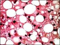 Dieta przy stłuszczeniu wątroby 